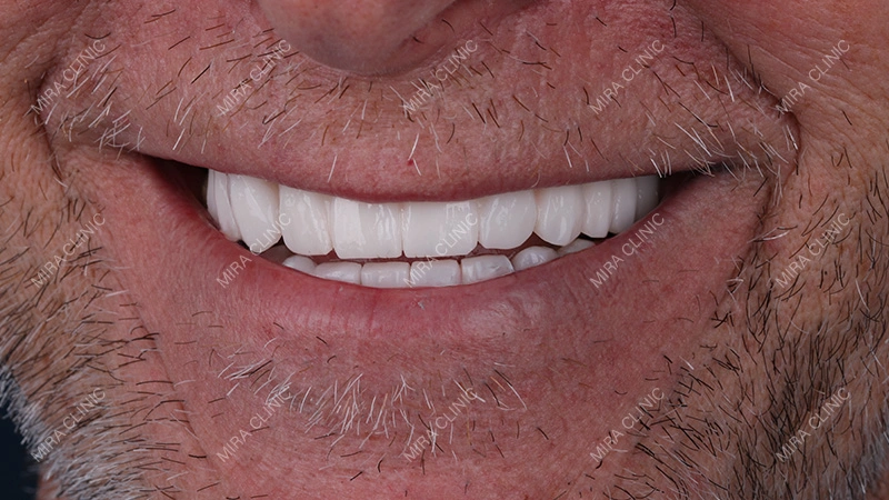 Full Smile Makeover With Crowns